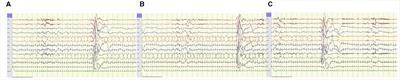 Utility and limitations of EEG in the diagnosis and management of ALDH7A1-related pyridoxine-dependent epilepsy. A retrospective observational study
